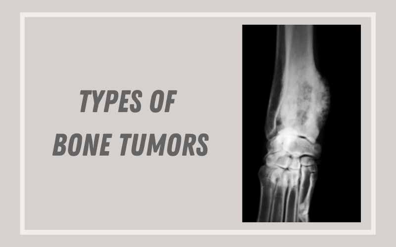 What Are The Different Types Of Bone Tumors?