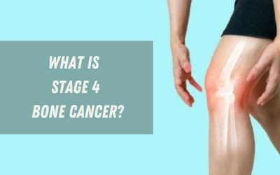 What is Stage 4 Bone Cancer?